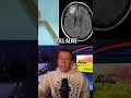Parasitic Worm Found In Woman s Brain