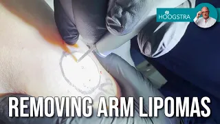 Arm lipomas - Laser treatment