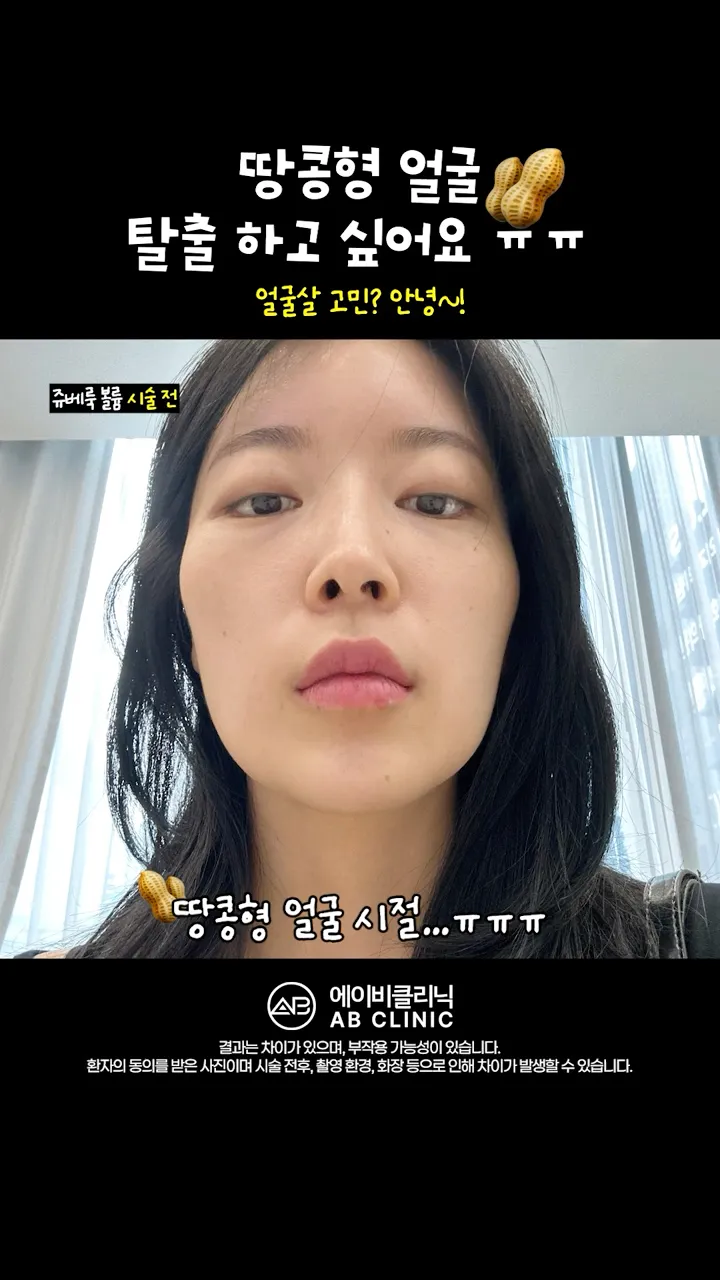 땅콩형 얼굴, 이 시술 받으세요!