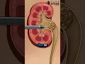 Download Lagu Kidney stone treatment | PCNL | #shorts