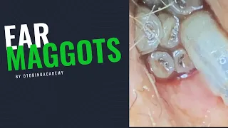 Download EAR MAGGOTS (COMPLETE VIDEO - FULL TREATMENT) MP3