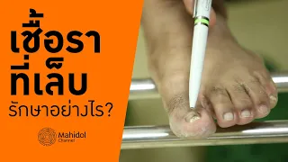  ทำไมการตรวจเชื้อราจึงต้องใช้วิธีขูดเล็บและส่งตรวจห้องปฏิบัติการ 