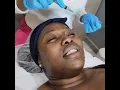All-in-One Microneedling Facial at Skin Reform