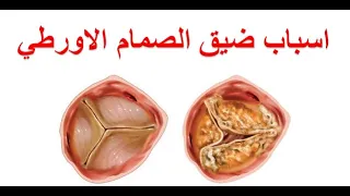 ما هي اسباب ضيق الصمام الاورطي كيف يؤثر ضيق الصمام الابهري على عضلة القلب و البطين الايسر 
