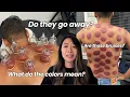What They DON T Tell You About Cupping Marks