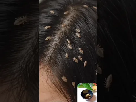 Best Home Remedy for Head Lice problem #shorts #haircare #beauty #hairgrowth