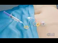 Chest Port Placement