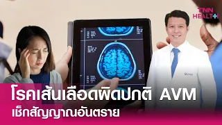 โรคเส้นเลือดผิดปกติในสมองเกิดจากอะไรบ้าง