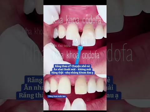 Đóng khe thưa - không mài răng #nhakhoacodofa #dentist #răngsứthẩmmỹ #lamdep #veneers