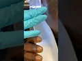 The Earigator clears an impacted ear