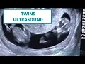 TAKE A PEEK Twins at 11 Weeks