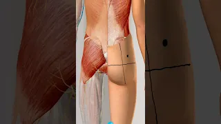 مكان الحقن العضلي 