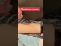 Nexplanon Birth Control Removal