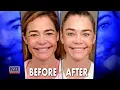 Denise Richards Undergoes Plastic Surgery By Dr Ben Talei - Inside Edition