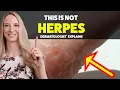 Dyshidrotic Eczema - Diagnosis Treatment Home Tips Dermatologist Explain
