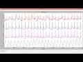 WxPython based Real time Vital Sign monitor GUI Demo