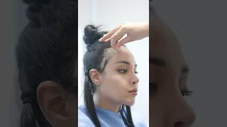 نتيجة تصغير الجبهة بزراعة الشعر تصغير الجبهة بعد 10 أيام تجربتي مع زراعة الشعر 