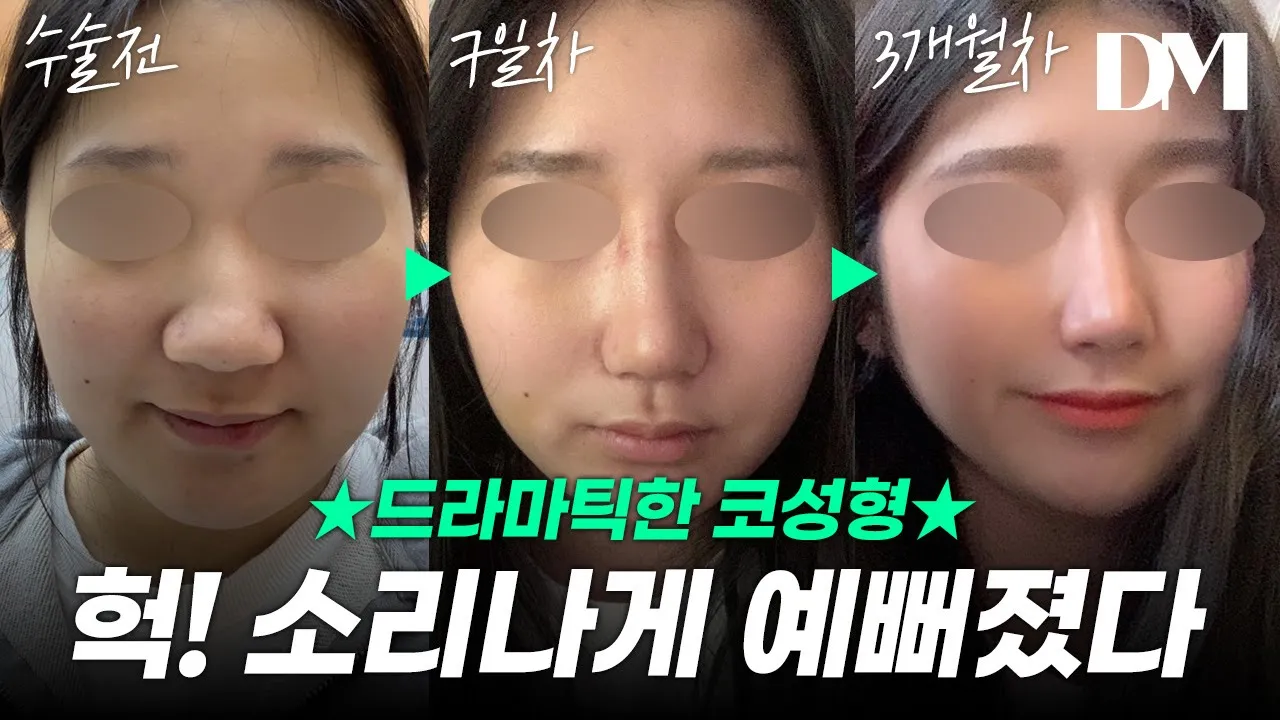 라면 보다 빠르게 확인 가능한 눈,코 성형 전/후 차이💥 #눈성형 #코성형 #디엠성형외과