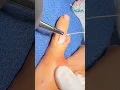 Lagu Severe boutonniere deformity after gym injury! procedure by Dr. Badia
