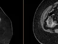 Intraperitoneal bladder rupture