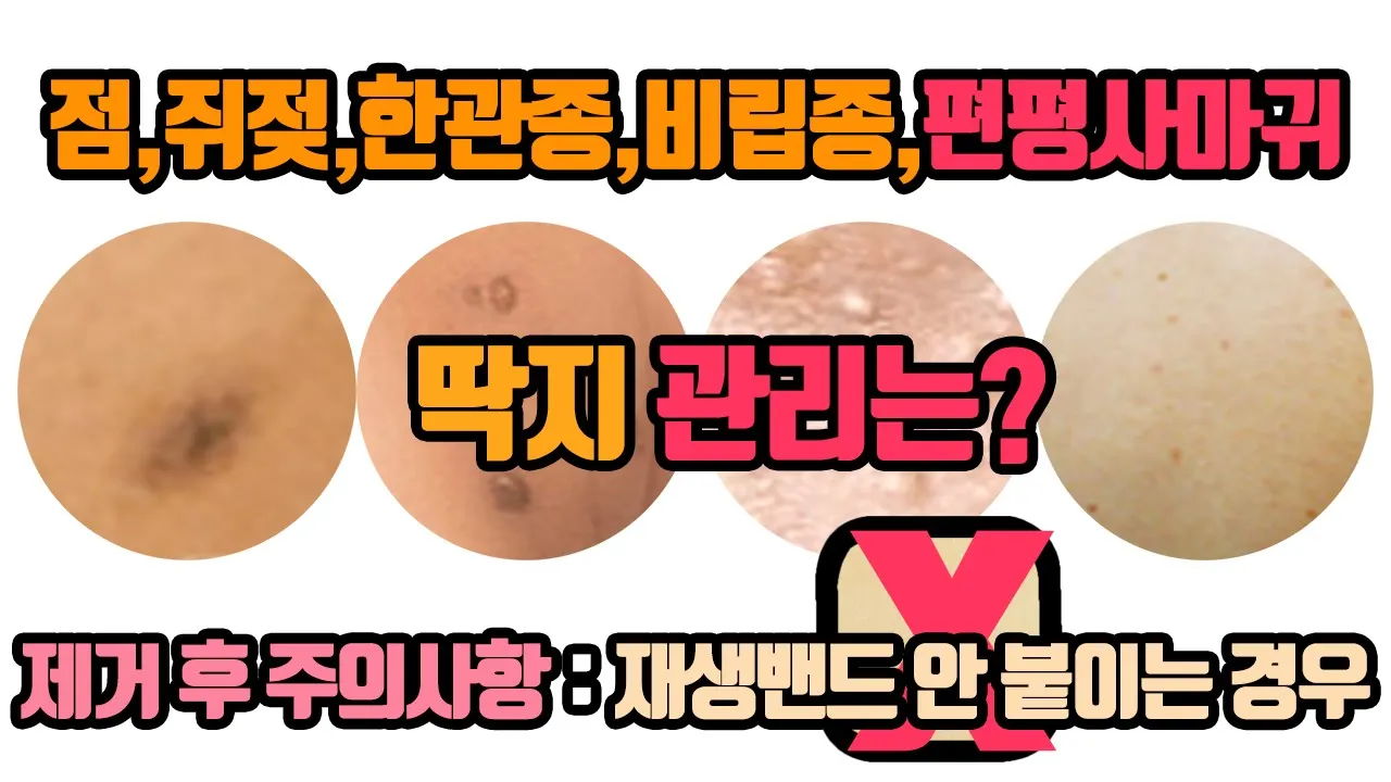편평사마귀,쥐젖,비립종,한관종,점 제거 시술 후 주의사항 - 딱지 관리가 핵심! (재생밴드 안 붙이는 경우)