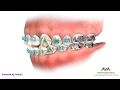 How to Wear Rubber Bands - Vertical or Triangle Upper 3 Lower 3 4