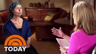 Chimp Attack Survivor Charla Nash Opens Up About Face Transplant Setback TODAY 