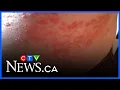 Shingles vaccine free for Nova Scotians 65 and over