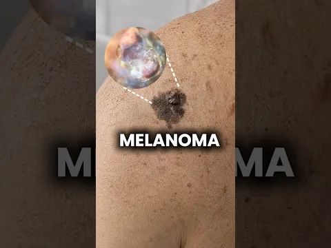 El cáncer de piel que más vidas ha arrebatado (melanoma). #dermatologia #dermatologo #medicina