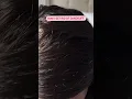 How I get rid of dandruff using a scalp massage brush
