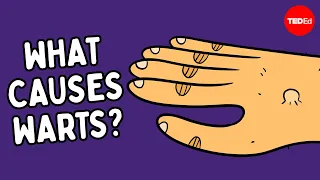 What are warts and how do you get rid of them - Cella Wright
