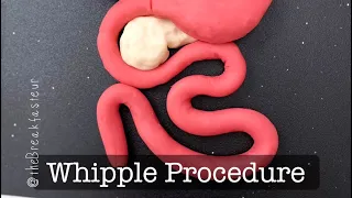 playdough surgery pylorus preserving pancreaticoduodenectomy aka whipple procedure part i