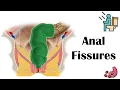 Anal Fissures - Causes Risk Factors Pathophysiology Signs Symptoms Diagnosis Treatment