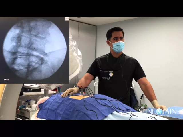 Radiofrequency Ablation Procedure