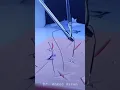 Laparoscopic suturing - surgical knot