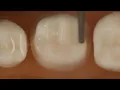 PFM Crown Posterior Tooth Preparation With Metal Occlusal