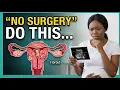 Fibroid Treatment WITHOUT Surgery What Doctors Try First