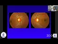 Optic Disc Assessment Make your Cup of Tea - Dr Harsh Kumar