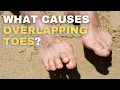 Overlapping Toes Causes and Solutions