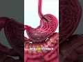 Percutaneous Endoscopic Gastrostomy PEG Tube Placement 3D Medical Animation