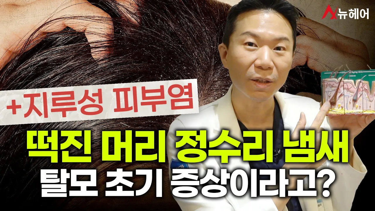 떡진 머리, 정수리 냄새나는 사람 클릭!!!! 내가 탈모?!!👆(지루성두피염과 탈모의 관계)ㅣ뉴헤어