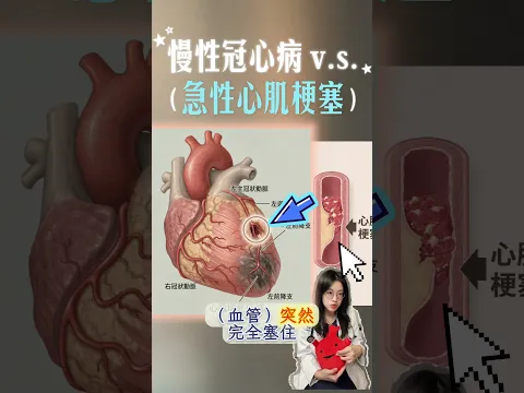 🏠冠心症 03【急性心梗是什麼？】🫀 「突然全塞」那天之前，我們有機會減少機率