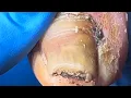 Download Lagu Onychomycosis Is Full Of Black Mud, And It’S Too Dirty To Remove The Nails!【Pedicure Master Lin Jun】