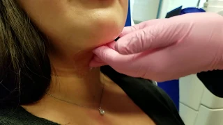 Post CoolSculpting Massage