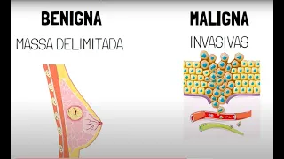 Neoplasia benigna x Neoplasia maligna