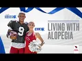 Living With Alopecia Cardinals QB Josh Dobbs and Cheerleader Ellie Share Their Journey