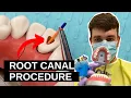 Download Lagu How Easily Do Endo on a Frontal Incisor – Step-by-Step
