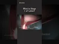 Download Lagu What is Stage 1 of Labor?  #shorts