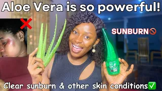 Download The most effective sunburn treatment 💯| how to use aloe Vera plant for sunburn | clear sunburn MP3