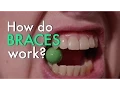 How Do Braces Work